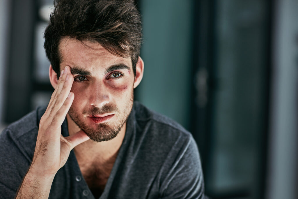 Domestic violence, bruise or face of sad man in house with depression, fear or anxiety for fighting, conflict or attack trauma. Facial, wound or victim with injury from abuse, disaster or horror ptsd.